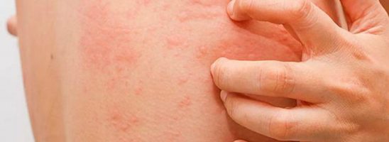 Herpes zoster, vaiolo delle scimmie e HIV: c’è un legame con il vaccino anti COVID-19?