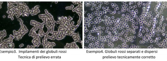 Impilamenti dei Globuli Rossi? Fenomeno reale o mal intepretato? Facciamo un po’ di chiarezza